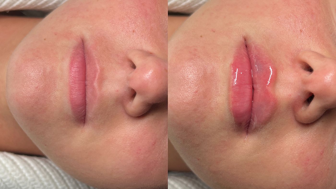 lip flip before and after
